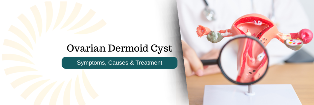dermoid cyst